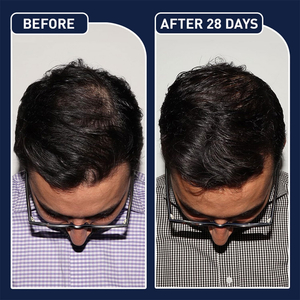 بخاخ نمو الشعر